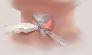 Paaf De Tireoide Guiada Por Ultrassonografia Curso De Ultrassonografia